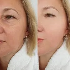 Mesoterapia francesa NCTF: qué es, cómo funciona y por qué se sigue utilizando